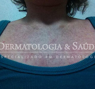 Lesões na pele de uma paciente com Zika