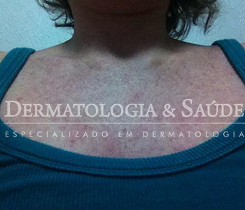 Lesões na pele de uma paciente com Zika