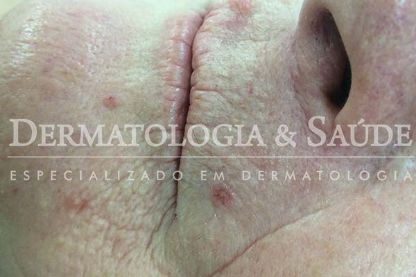 10-maneiras-de-suspeitar-que-voce-esta-com-cancer-de-pele-dermatologia-e-saude-1