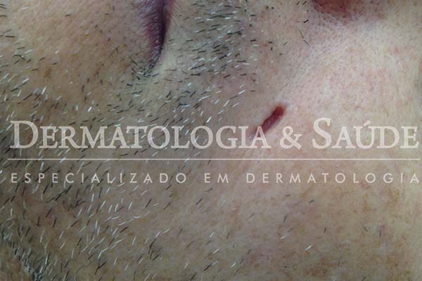 10-maneiras-de-suspeitar-que-voce-esta-com-cancer-de-pele-dermatologia-e-saude-11
