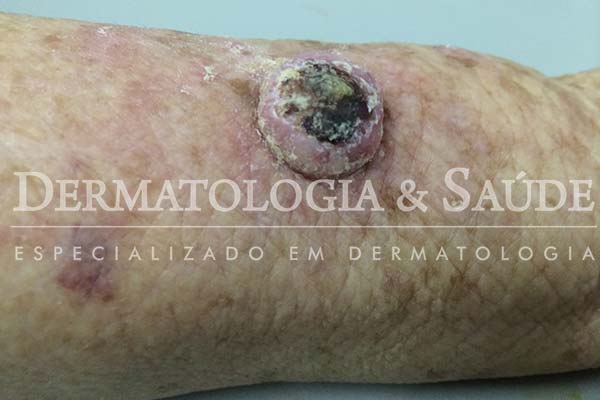 10-maneiras-de-suspeitar-que-voce-esta-com-cancer-de-pele-dermatologia-e-saude-13