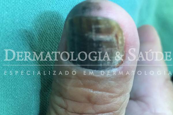 10-maneiras-de-suspeitar-que-voce-esta-com-cancer-de-pele-dermatologia-e-saude-15