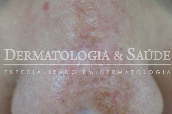 10-maneiras-de-suspeitar-que-voce-esta-com-cancer-de-pele-dermatologia-e-saude-17