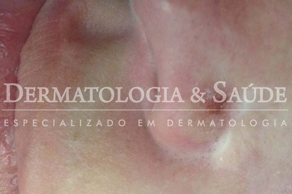 10-maneiras-de-suspeitar-que-voce-esta-com-cancer-de-pele-dermatologia-e-saude-19