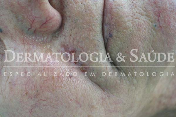 10-maneiras-de-suspeitar-que-voce-esta-com-cancer-de-pele-dermatologia-e-saude-3