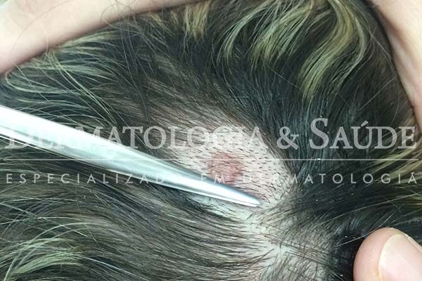 10-maneiras-de-suspeitar-que-voce-esta-com-cancer-de-pele-dermatologia-e-saude-5