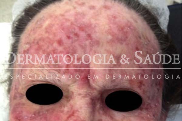 10-maneiras-de-suspeitar-que-voce-esta-com-cancer-de-pele-dermatologia-e-saude-7