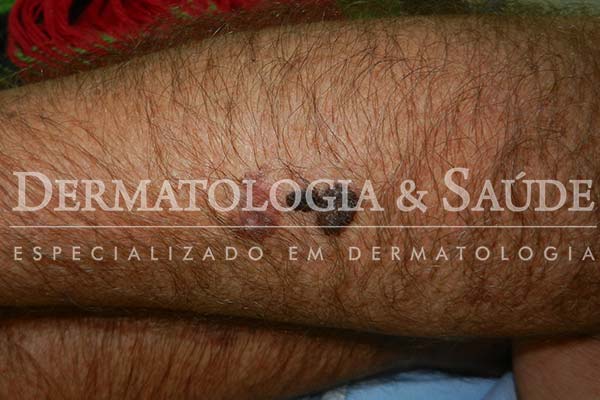 10-maneiras-de-suspeitar-que-voce-esta-com-cancer-de-pele-dermatologia-e-saude-9