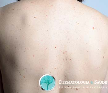 12-motivos-que-aumentam-sua-chance-de-ter-cancer-de-pele-dermatologia-e-saude-3