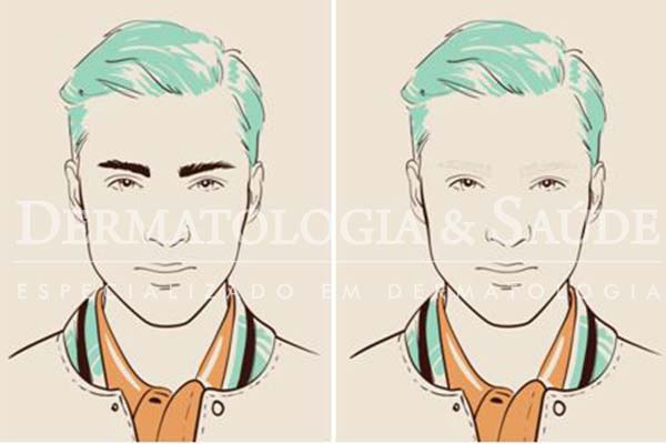 Sem sobrancelhas ou com sobrancelhas muito ‘apagadas’ o rosto toma um aspecto triste ou ‘sem expressão’.