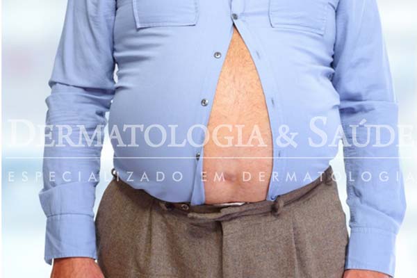 Demonstração sobre ocmo surgem as estrias 