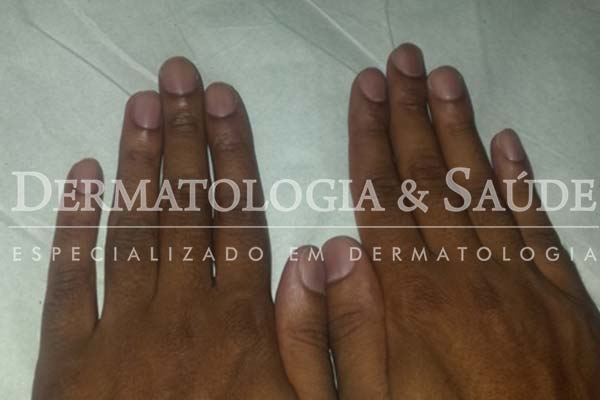 Faixas marrons em todas as unhas das mãos – melanoníquia racial