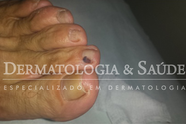 Hematoma causado por sapato apertado