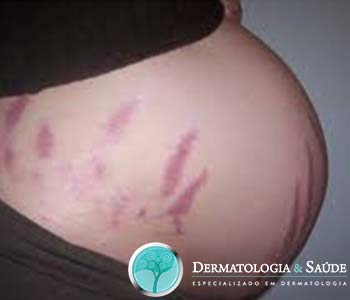 estrias recentes são avermelhadas. 