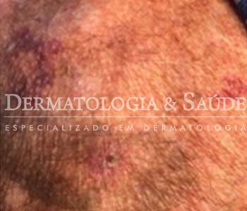 porque-comecaram-a-aparecer-manchas-roxas-nos-meus-bracos-dermatologia-e-saude-3