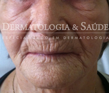 paciente com envelhecimento intenso da pele