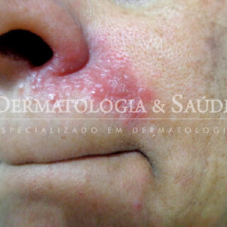 Bolinhas vermelhas na pele