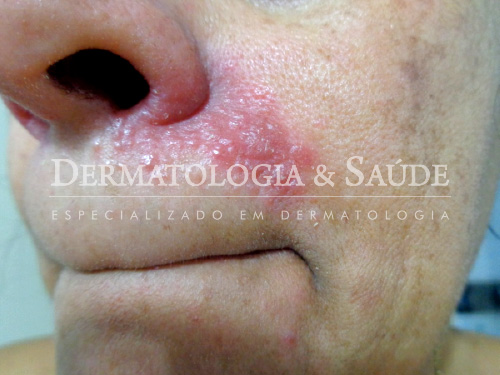 Bolinhas vermelhas na pele