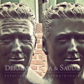 Botox e preenchimento