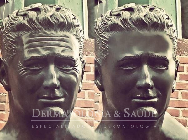 Botox e preenchimento