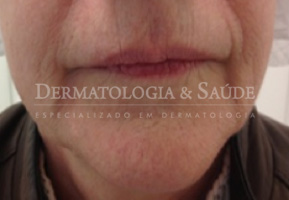 Contorno inferior do rosto