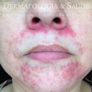Dermatite Perioral