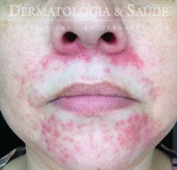 Dermatite Perioral