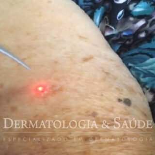 Laser - manchas solares