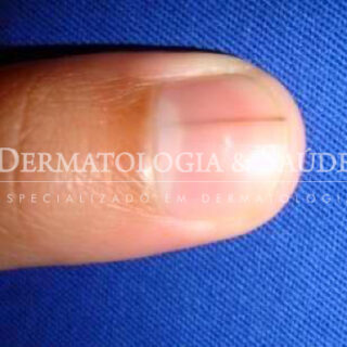 Listra escura nas unhas