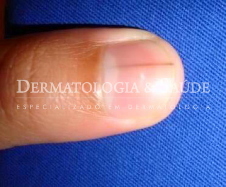 Listra escura nas unhas