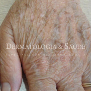 Como se livrar das manchas de idade nas mãos?