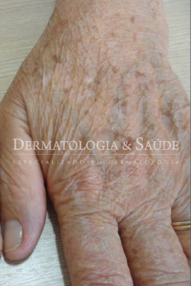 Como se livrar das manchas de idade nas mãos?