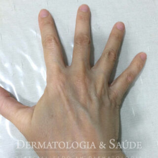 Como prevenir as manchas de idade nas mãos?