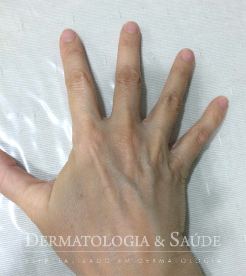 Como prevenir as manchas de idade nas mãos?