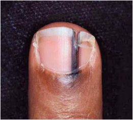 faixa negra acometendo unha e pele