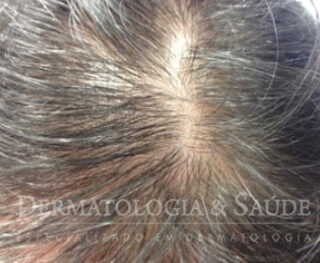 Causas de queda de cabelo