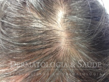 Causas de queda de cabelo