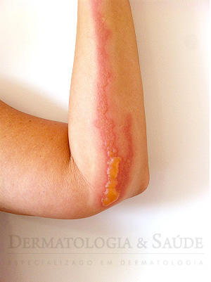 Fitofotodermatode no braço