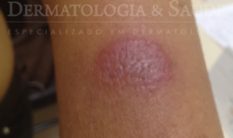 hanseniase paucibacilar