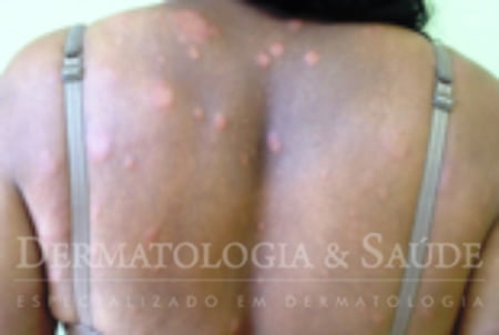 Hanseniase multibacilar