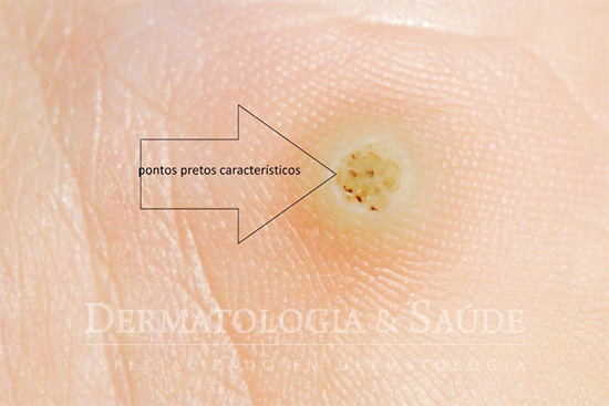 Bolinhas vermelhas na pela são verrugas?
