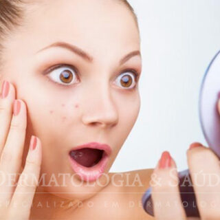 Cremes e maquiagem causam espinhas?