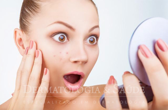 Cremes e maquiagem causam espinhas?