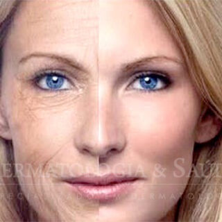 Preenchimento de rugas