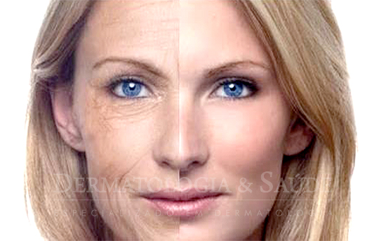 Preenchimento de rugas