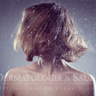 Dermatite seborreica (Caspa)