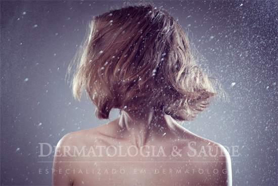 Dermatite seborreica (Caspa)