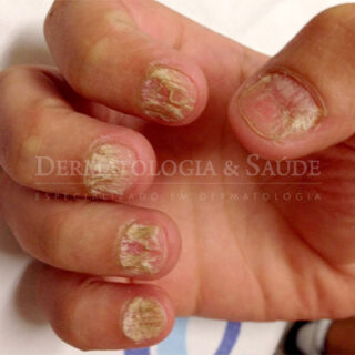 Liquen plano na unha