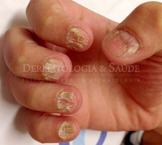 Liquen plano na unha