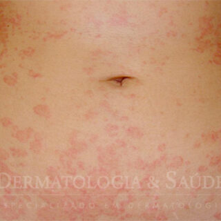 Pitiriase rosea